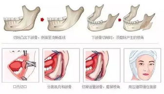 演艺界の隐形换头宝陈数 如何成为削骨手术的成功典范 