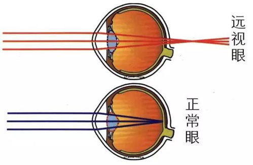 远视眼可以恢复成正常视力吗