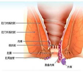 吃香喝辣一时爽,痔疮发作遭了殃 5个字读懂长痔疮不能吃什么