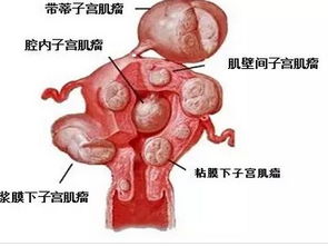 专家提醒 子宫小肌瘤可以观察观察,不必着急手术