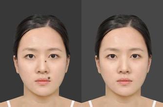 杭州 女子 办护照 得开点痣证明 因整容脸上少一 