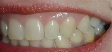 2019 06 18百会口腔洗牙真的会导致牙缝变宽 牙齿松动吗