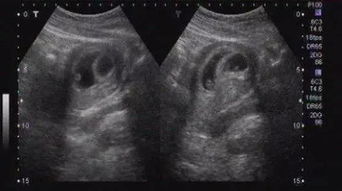 辟谣 怀孕50天,超声看孕囊能看出男女 
