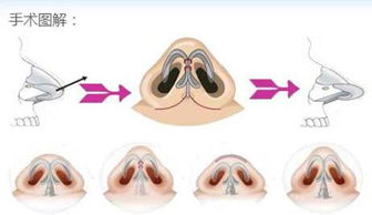隆鼻的几种不同手术方法介绍 搜狐 