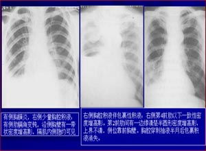 胸膜炎16年了有胸膜粘连。那时没钱就找中医做了火疗。现在我想知道是不是结核性的做什么检查。