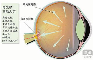 青光眼是怎么得的呢(青光眼是怎么形成的呢)