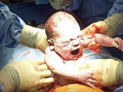 产房实拍,宫剖产宝宝出生的经典瞬间 