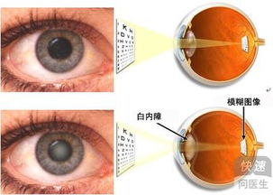 白内障治疗拖不得 白内障的治疗详解
