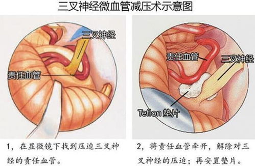 生命不能承受之痛 三叉神经痛