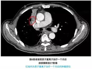 体积巨大型肺癌更适合质子重离子精准放射治疗