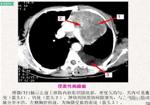 纵膈肿瘤是什么情况