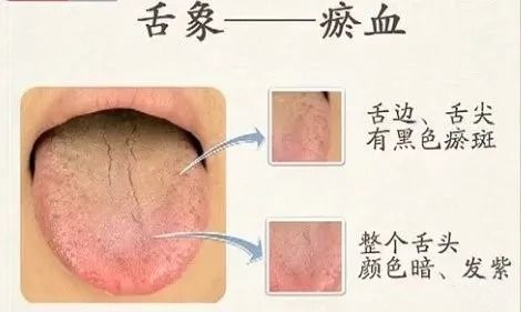 观舌象辨证型,中医舌诊 暗藏玄机 附 舌诊图谱