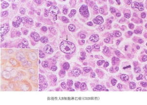 非霍奇金淋巴b细胞瘤用什么方案，治疗弥漫性大B细胞淋巴瘤首选的方案是()