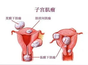 子宫腺肌瘤与子宫肌瘤的区别是什么