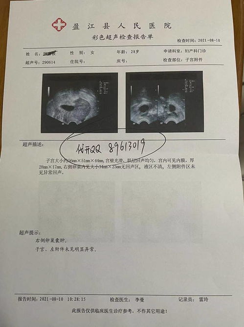初B超检查单上四个指标,怀孕血检HCG单准妈咪 坐胎稳定 拒绝宫外孕B超图