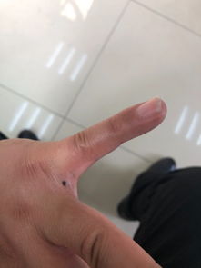 左手小拇指和中指之间长痣代表什么 