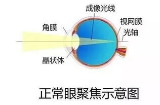 近视300度以下的必须懂 高度近视不能承受之痛