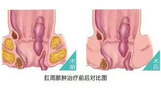 宜昌长航肛肠医院 区分肛周脓肿与痔疮的3方式,你一定要知道 