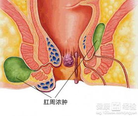 肛周脓肿手术后伤口一直不长肉怎么办呢