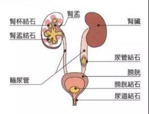 小心啦 立夏过后结石病开始 作妖 了 