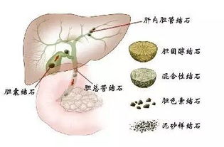 肝内胆管结石要做手术吗