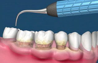 有牙周病的可以洗牙吗 