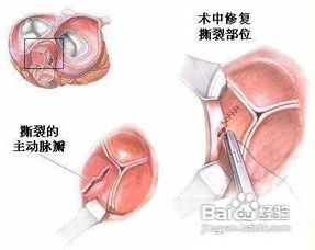 主动脉型心脏的改变 