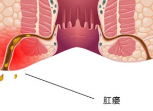 怎么判断是不是肛瘘