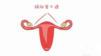 备孕1年没怀可以检查输卵管是否通畅吗，可以试管助孕吗？