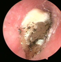 外耳道真菌图片 搜狗图片搜索