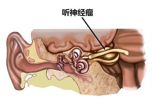 耳鸣 眼睛胀痛 面部发麻以为是脑梗,却检查出听神经瘤