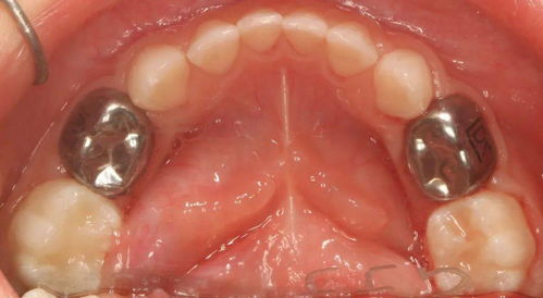 乳牙树脂冠做法(乳牙前牙树脂预成冠)