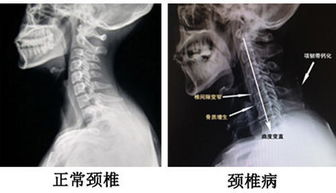 中医怎么治疗颈椎病(中医怎么治疗颈椎病效果好)