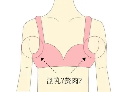 副乳有什么危害 广州高尚形体雕塑提醒 有可能会引起这些疾病