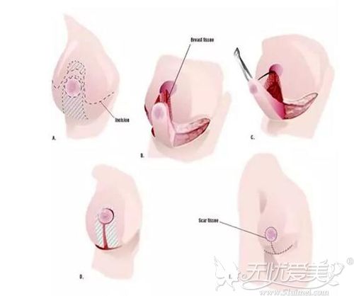 胸大又下垂可以做缩胸手术吗 失败了还能恢复吗