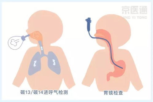 超50 的人感染幽门螺杆菌 医生告诫这几类人要根治