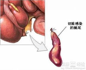 阑尾炎有效止痛方法是什么