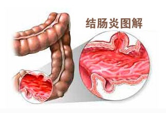 治疗结肠炎医院哪里好 