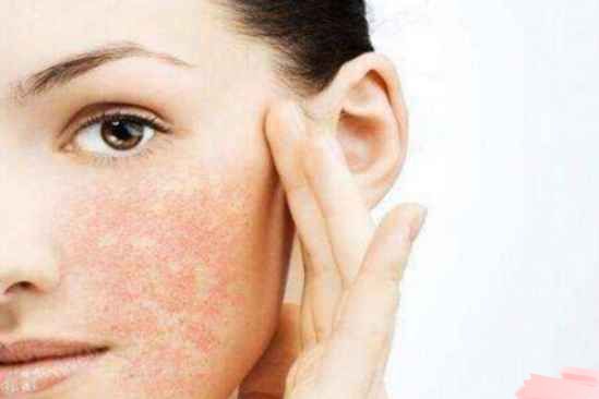 敏感肌肤的特征 敏感性皮肤怎么修复