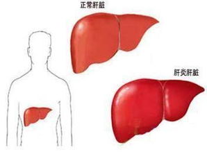 谷丙转氨酶升高对肝脏有什么影响 