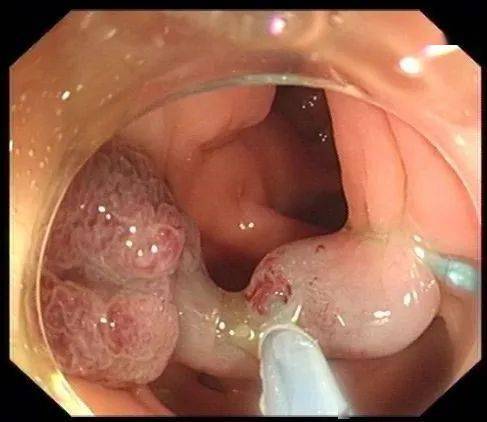 肠息肉镜下切除术及术后复查