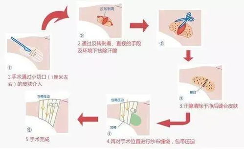 腋臭太尴尬,微创手术消灭它