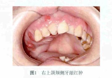 牙医一定要重视拔牙禁忌症,这个案例给了我们启示