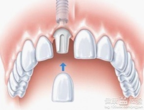 没有牙根可以做种植牙吗