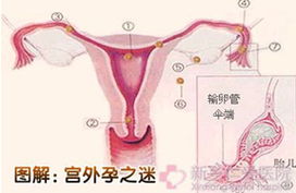 贵阳宫外孕治疗的最佳时间