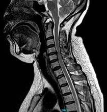 颈椎椎管狭窄手术风险 