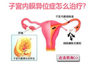 子宫内膜异位症怎么检查出来