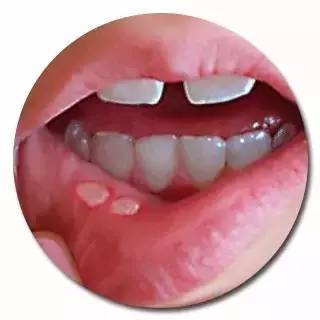 嘴巴长口腔溃疡怎么快速消除,怎样去除口腔溃疡