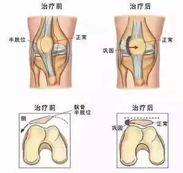 髌骨软化症自我疗法