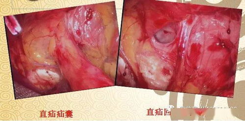 腹腔镜腹股沟疝完全腹膜外疝修补 TEP 术后康复注意事项